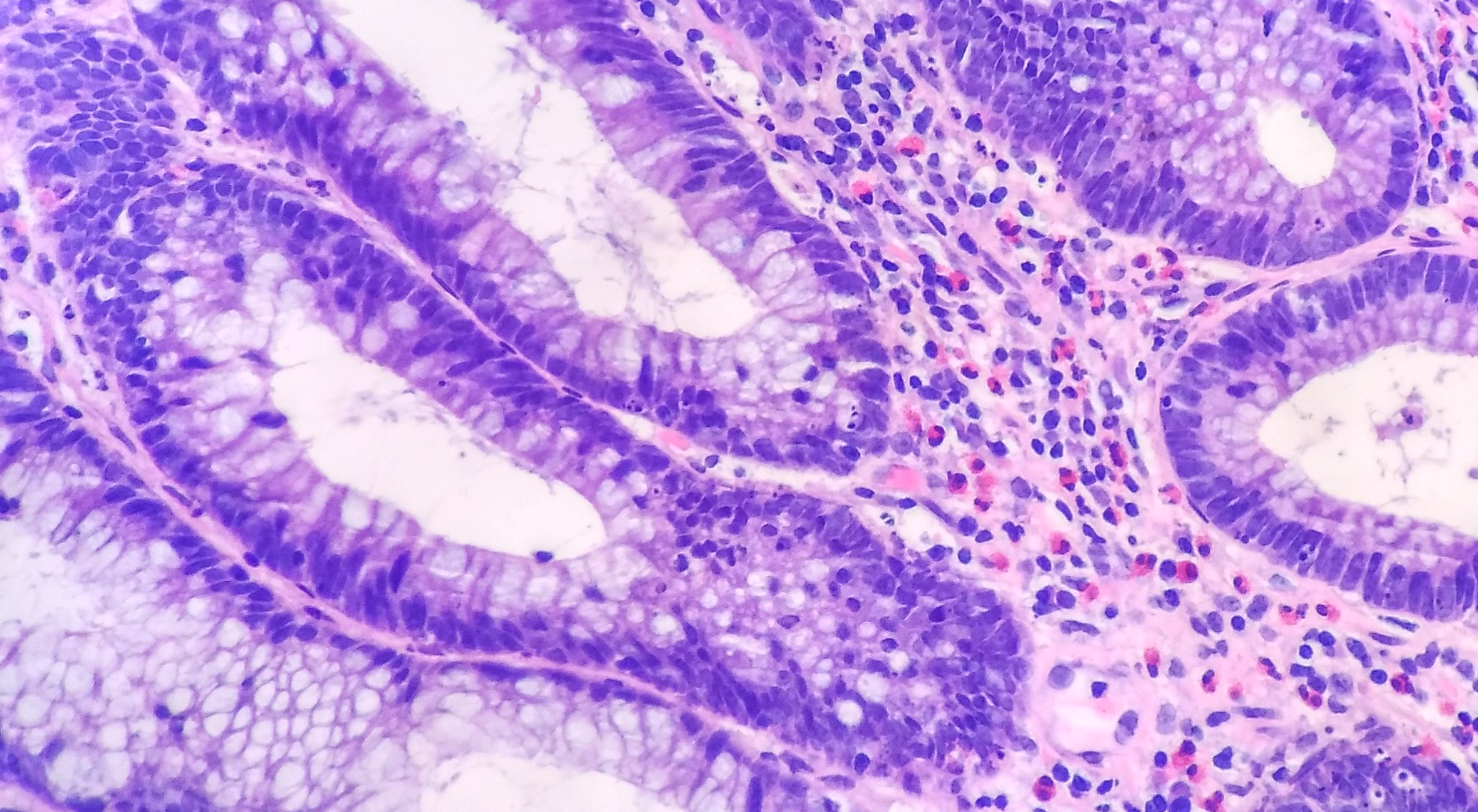 肠管状腺瘤伴腺上皮低级别上皮内瘤变 (2).jpg
