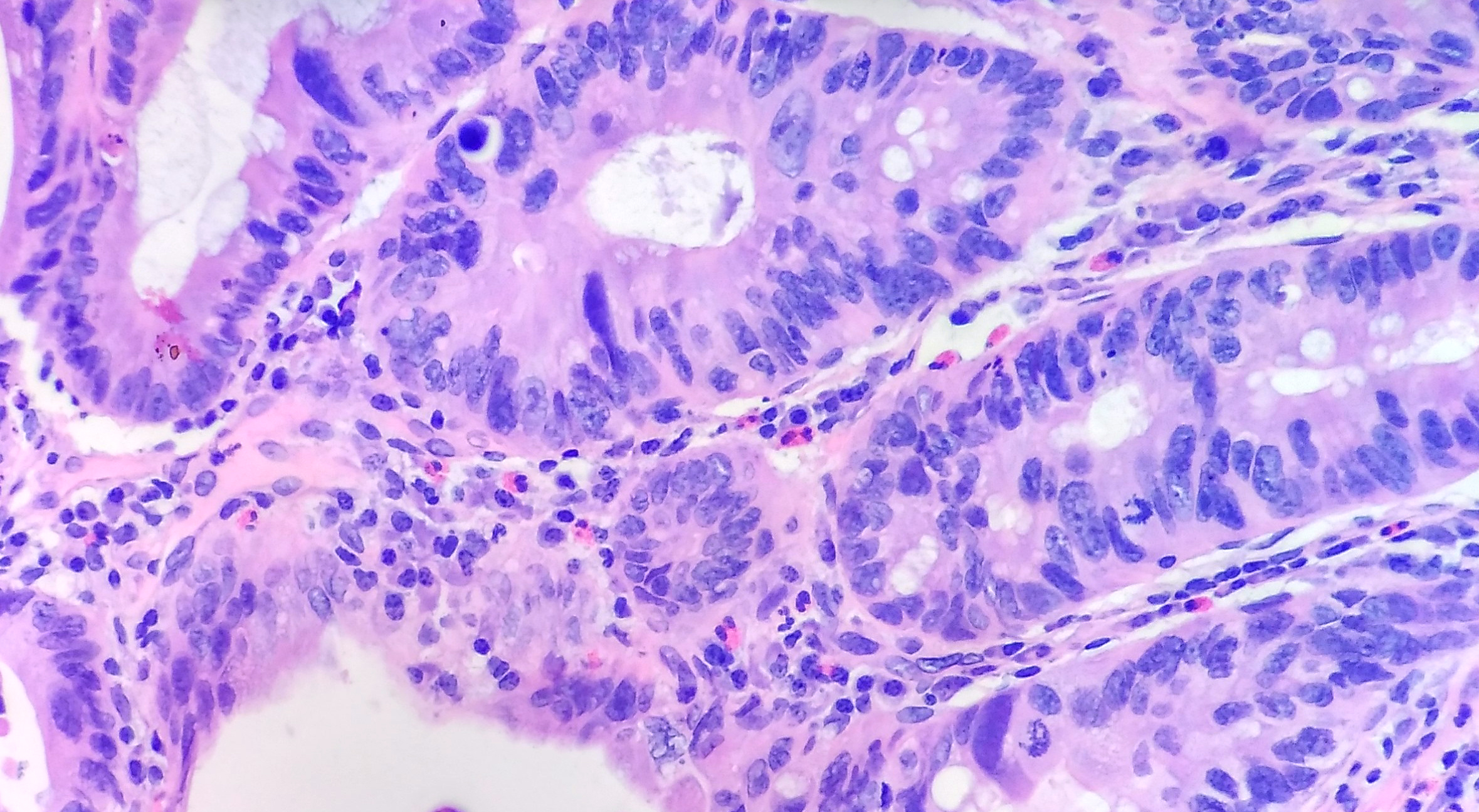 肠管状腺瘤伴腺上皮高级别上皮内瘤变 (4)-cecf.jpg